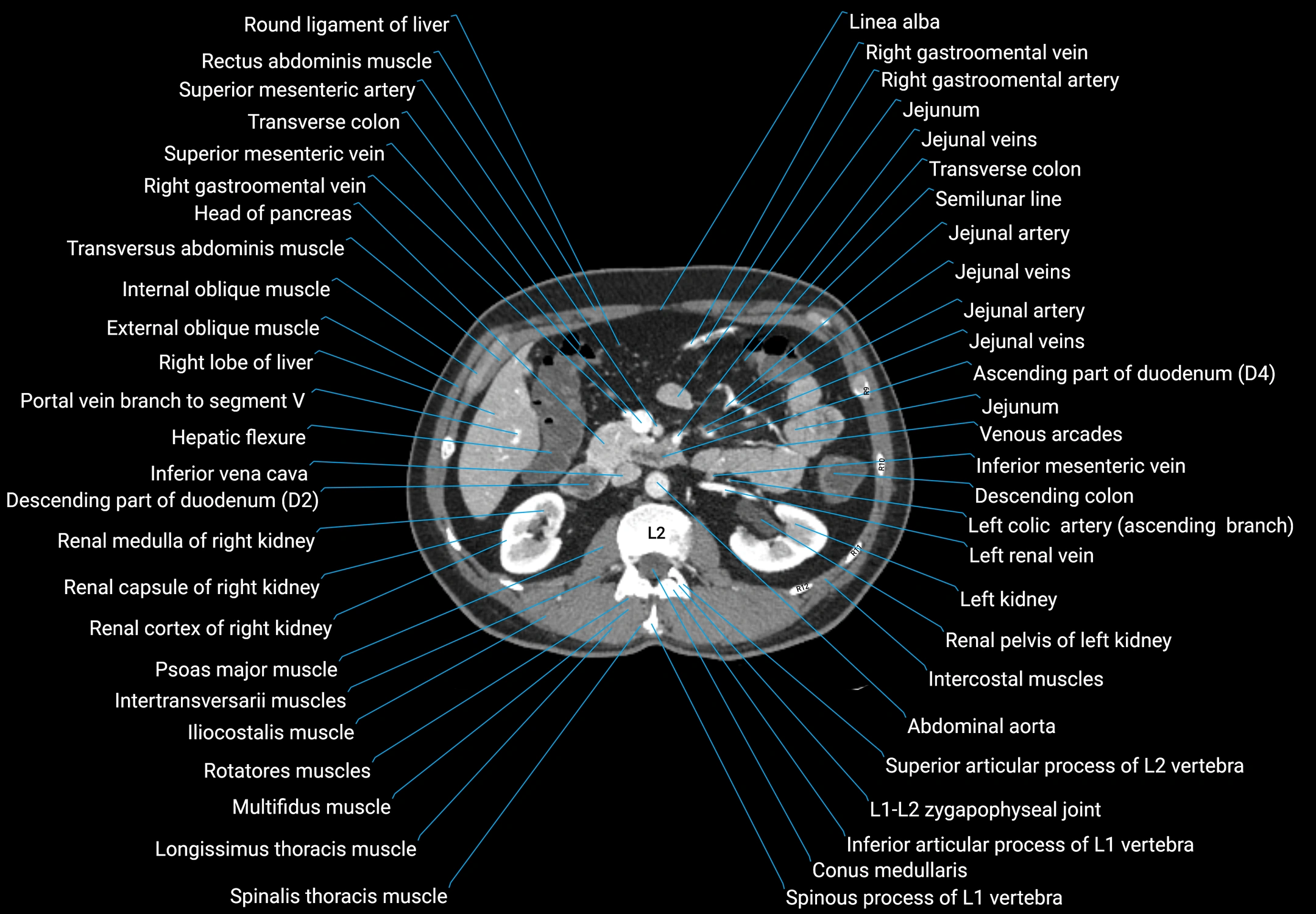 CT male pelvis axial cross sectional anatomy labelled radiology image -00068.webp
